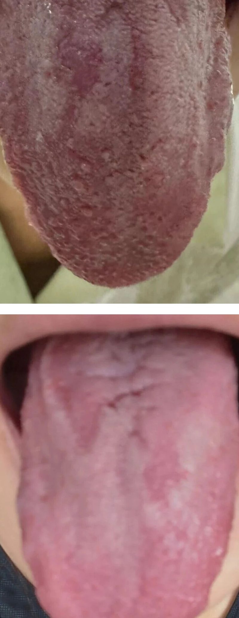 许盼盼医生舌诊对比图-霉菌性阴道炎HPV82治疗前后